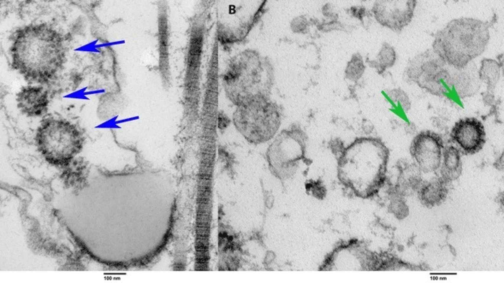 Coronavirus detectado en el tejido testicular de un paciente positivo vivo (izquierda) y fallecido (derecha).