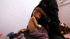 Un niño con severos signos de malnutrición en Yemen.