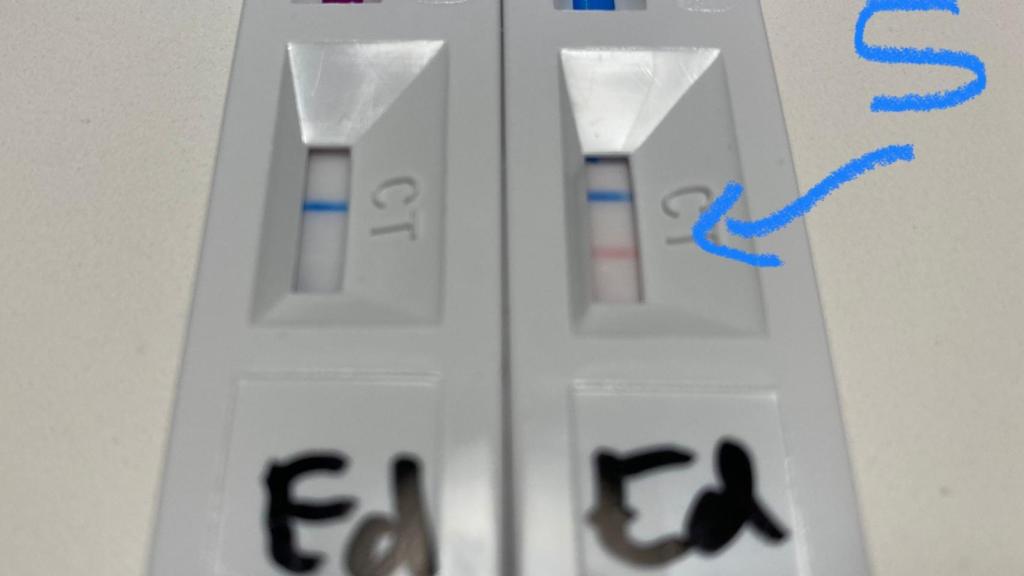 Resultados de dos test rápidos de anticuerpos con la misma muestra.