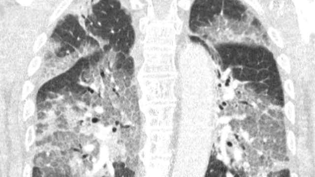 Escáner de los pulmones del paciente neerlandés al que se le había ofrecido una inyección de AstraZeneca.