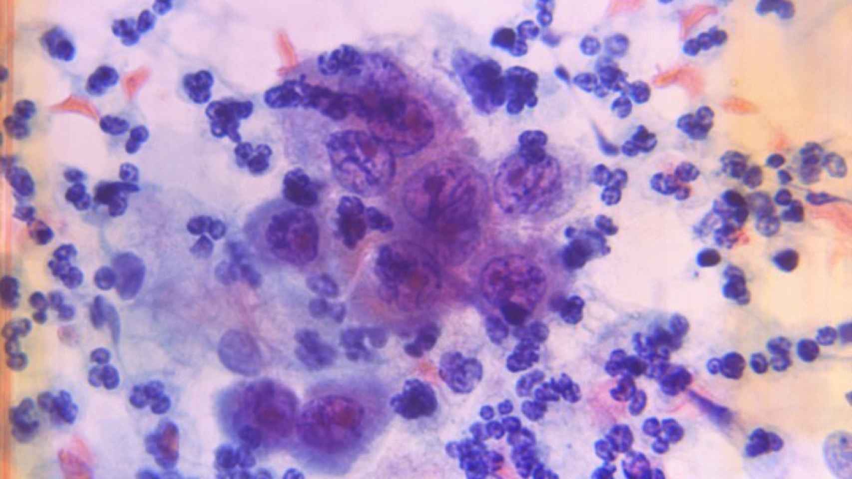 Imagen microscópica de células cancerígenas (en púrpura). Fuente: CDC