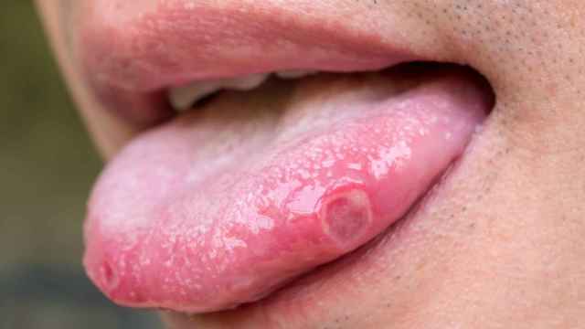 Remedios caseros para las llagas en la boca (aftas)