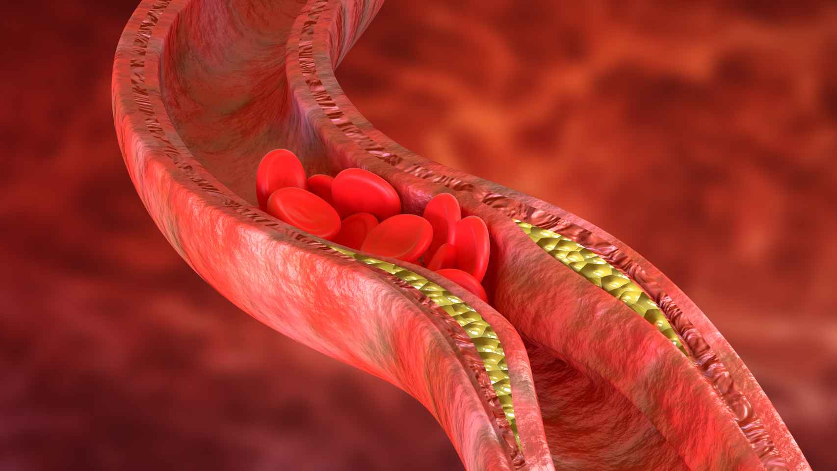 Placas de colesterol en las paredes de las arterias.