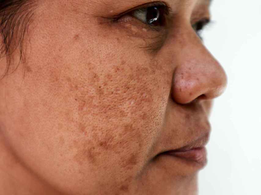 Susteen Caballo metálico El tratamiento más eficaz para las manchas de sol en la cara