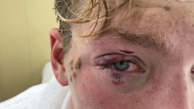 El nadador Hector Pardoe y el estado de su ojo tras ser golpeado en los Juegos Olímpicos de Tokio