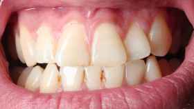 Métodos para evitar el sarro en los dientes