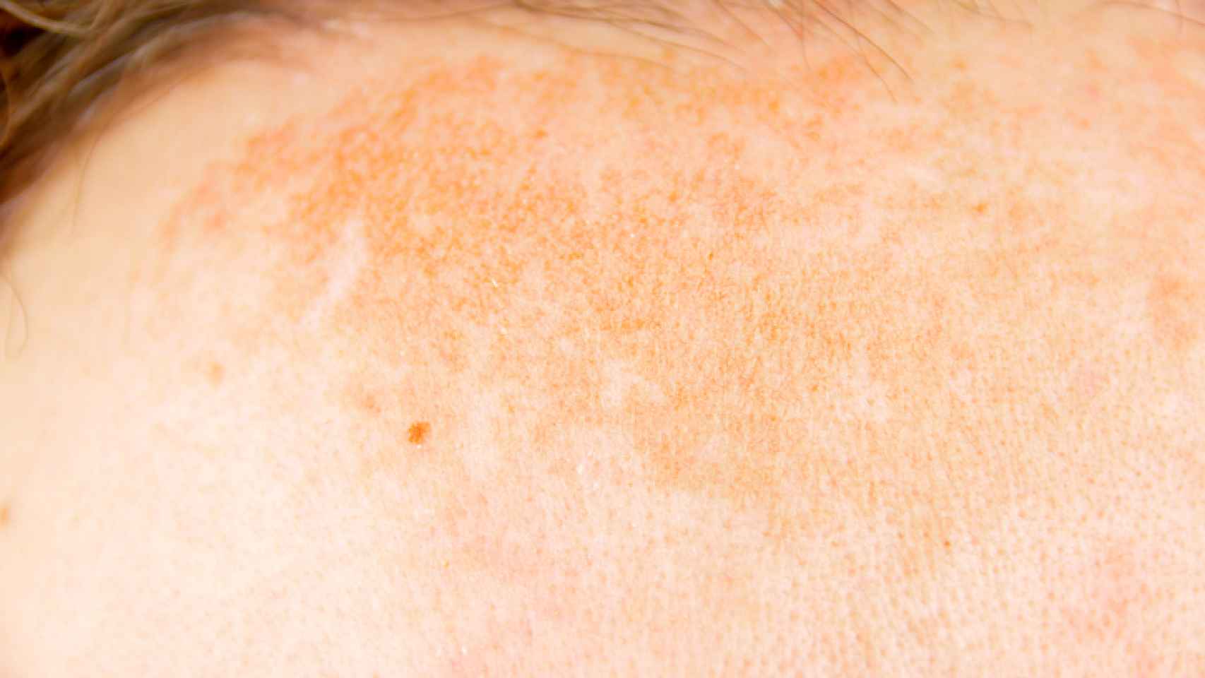 Manchas solares en la piel: por qué se producen y cómo eliminarlas