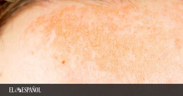 Cómo manchas solares de piel (remedios caseros)