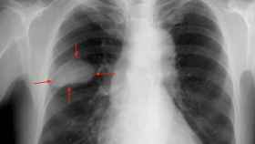 Una radiografía de los pulmones de un paciente con un tumor.