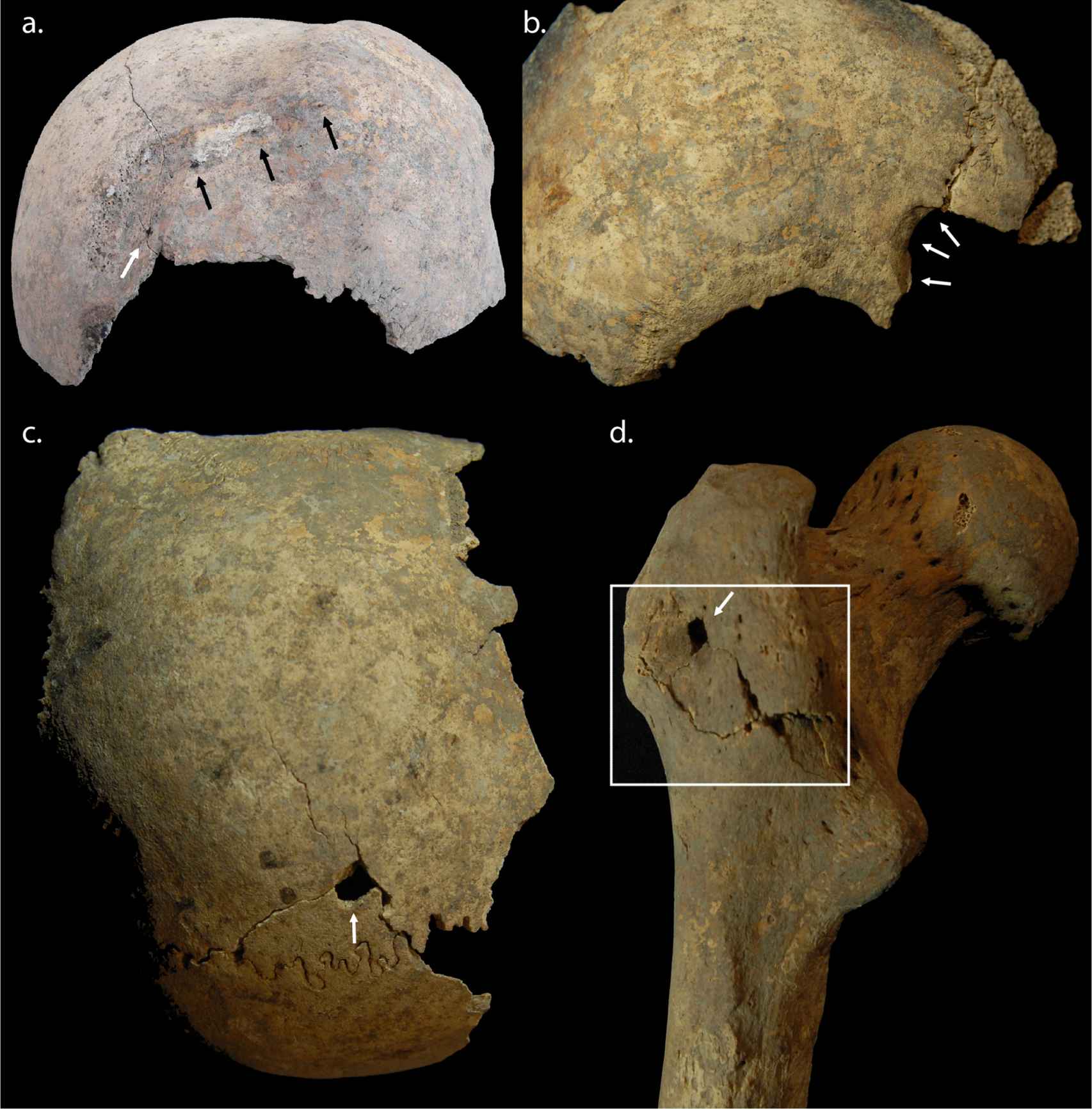 Ejemplos de lesiones documentadas en los huesos de los cruzados de Sidón.