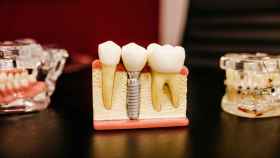 El implante puede mantener los dientes libres de bacterias.