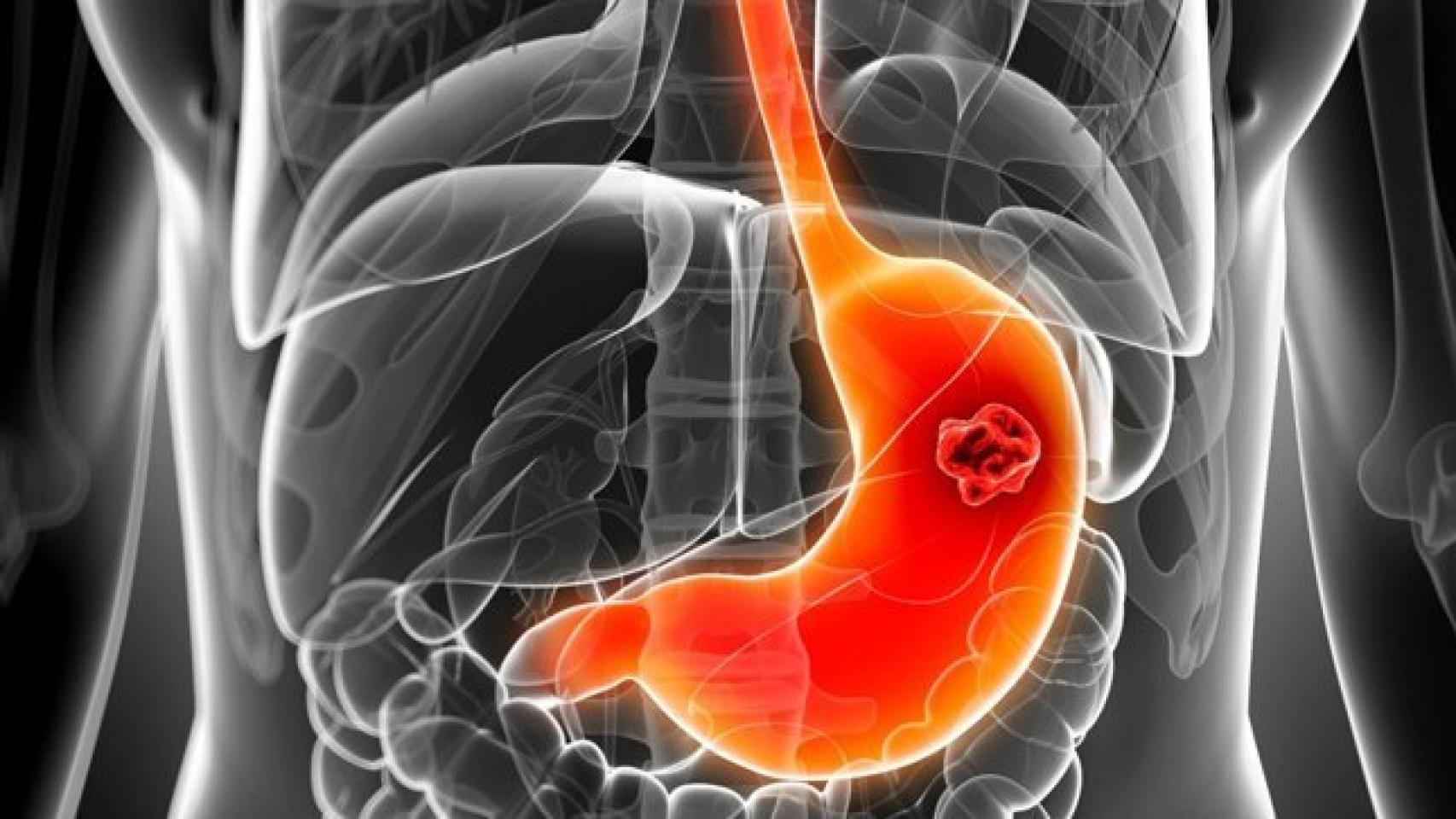 Cáncer de estómago los nueve síntomas comunes que deben hacerte sospechar