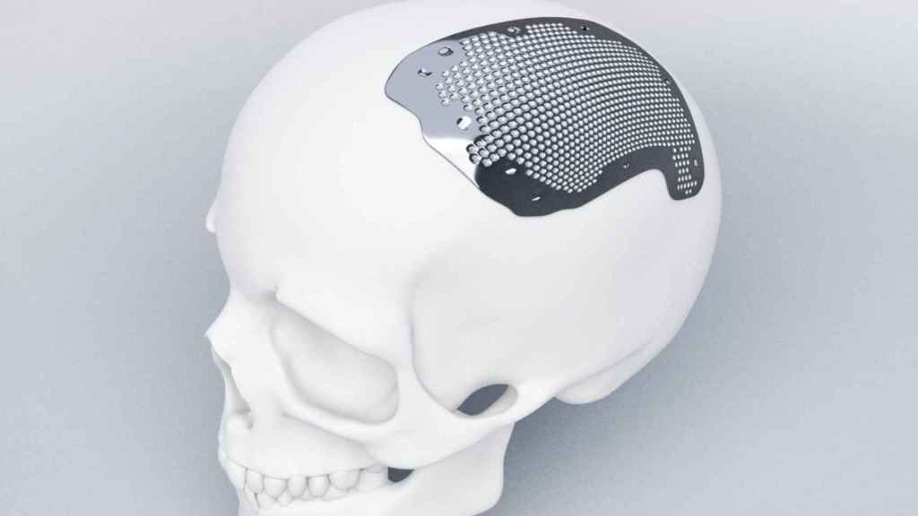 Placa para el cráneo diseñada, desarrollada y fabricada por Customimplants.