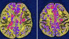 Un escáner cerebral que muestra la progresión de la esclerosis múltiple.