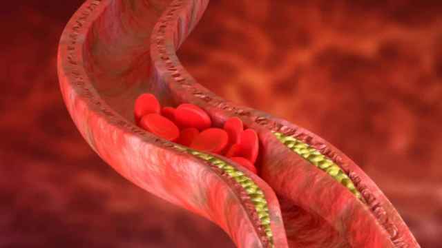 Representación de una arteria con colesterol en sus paredes.