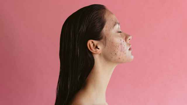 El 5,4% de los adultos europeos tiene acné.