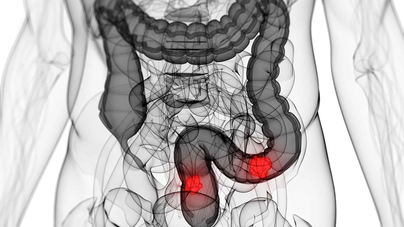 Los síntomas tempranos del cáncer de colon: así comienza el tumor más  diagnosticado en España