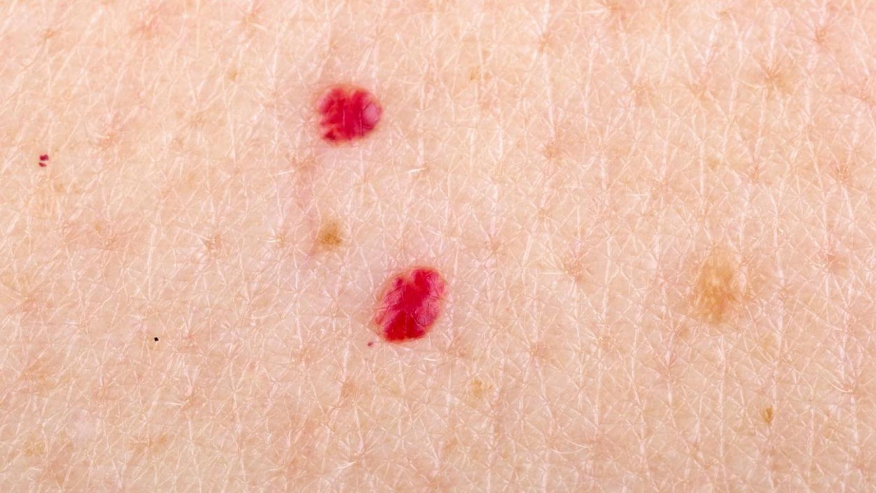Quagga Shuraba lucha Qué son los puntos rojos que aparecen en la piel: todo lo que se sabe de  estos tumores