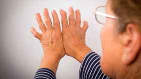 Las manos de una paciente con artritis reumatoide. EP.