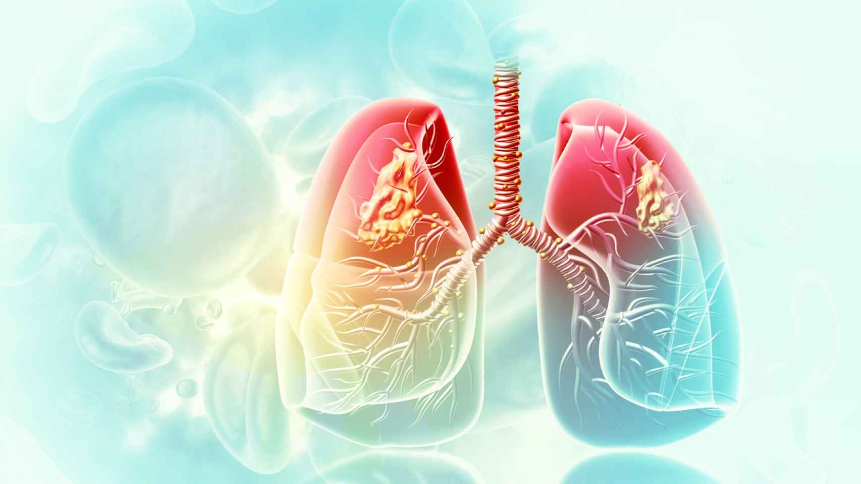 El de pulmón fue el segundo cáncer más diagnosticado en el mundo en 2020.