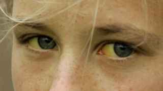 Una niña con ictericia, la coloración amarillenta de los ojos.
