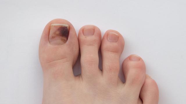 ¿Por qué hay personas con las uñas de los pies negras después de las vacaciones de Semana Santa?