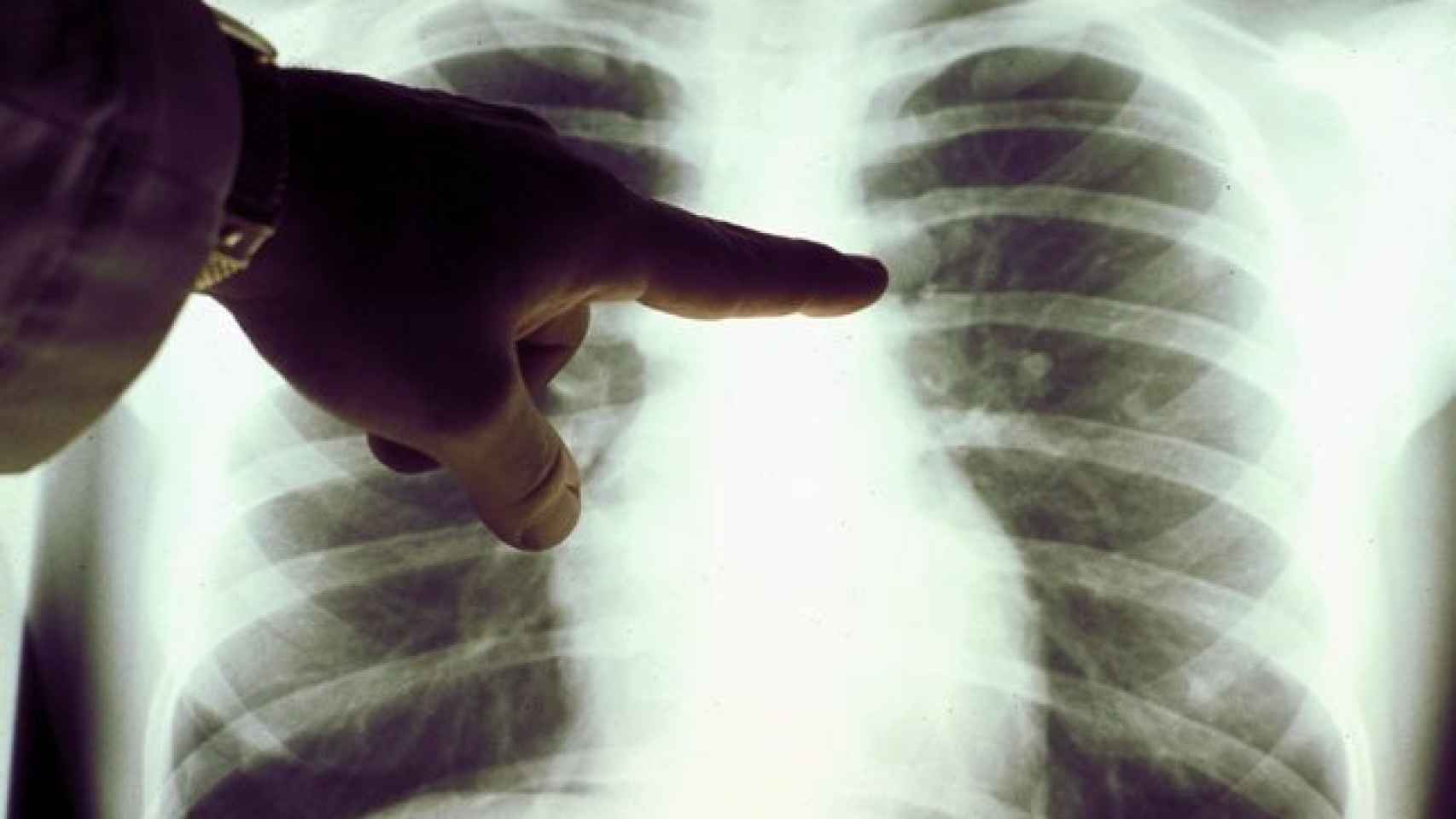 Un médico señala una radiografía de tórax.