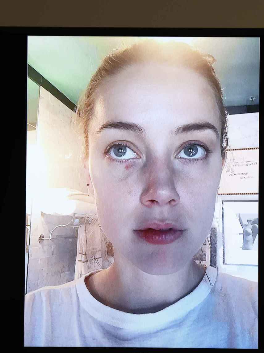 La actriz ha aportado fotografías con lesiones supuestamente producidas por Depp durante sus peleas.