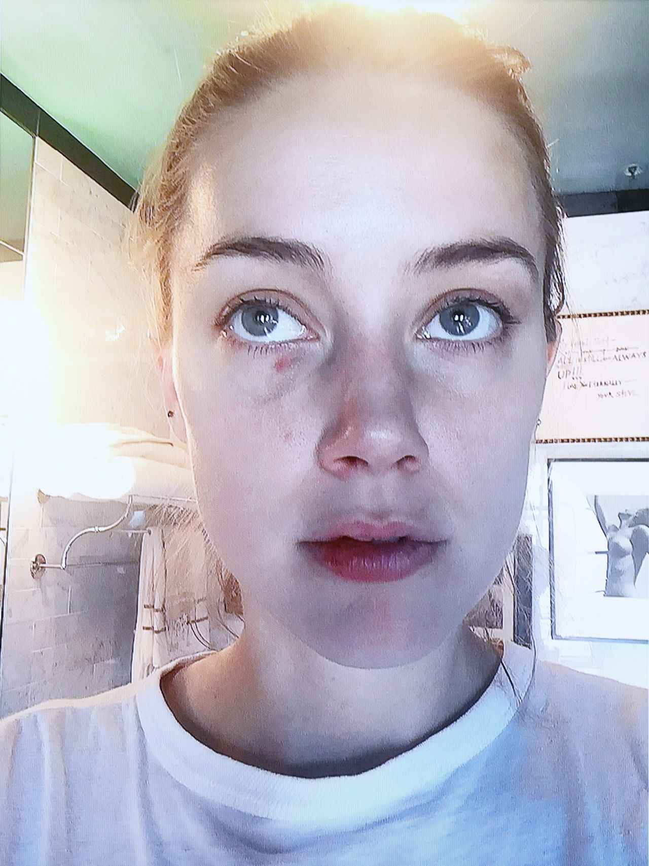 La actriz ha aportado fotografías con lesiones supuestamente producidas por Depp durante sus peleas.