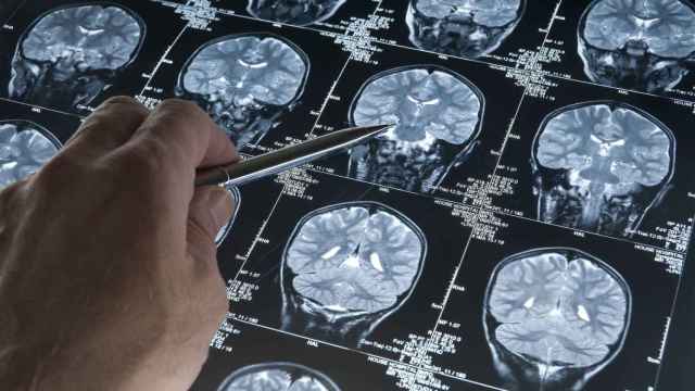 Un sanitario analizando un escáner cerebral.