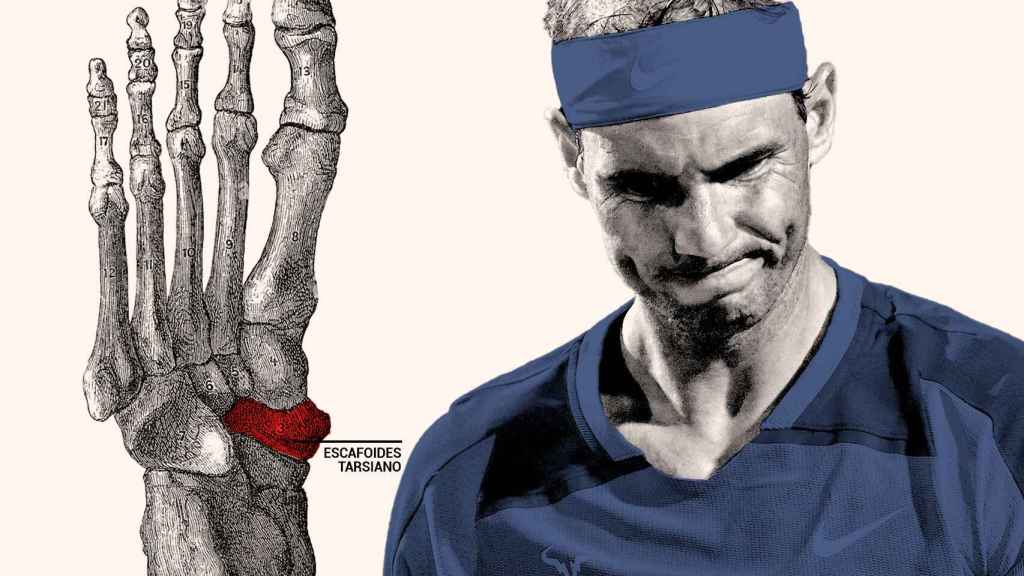 Rafael Nadal y su lesión en el pie