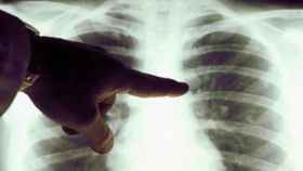 Una prueba diagnóstica por imagen es clave para localizar el cáncer de pulmón.