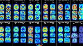 Terremoto en la lucha contra el alzhéimer: la principal hipótesis de la enfermedad se tambalea