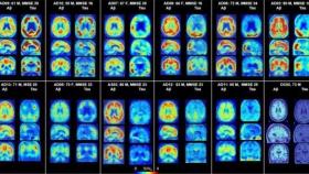 PET del cerebro que muestra placas amiloides y proteínas tau en Alzheimer