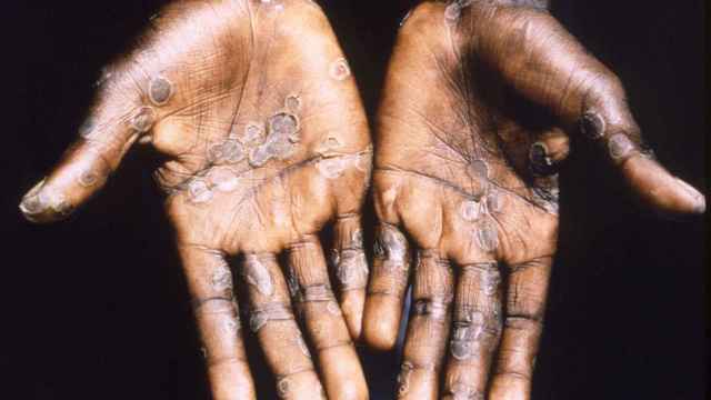 Las manos de un contagiado por viruela del mono en Congo en 1997. Brian W.J. Mahy/CDC.