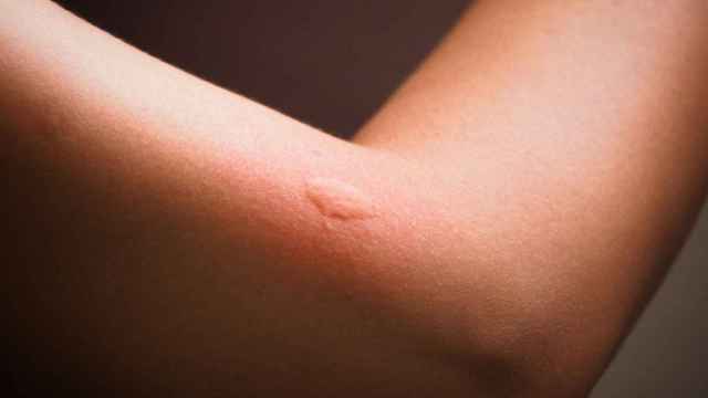 Las picaduras de mosquito y su reacción alérgica.