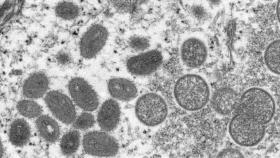 Virus de la viruela del mono.