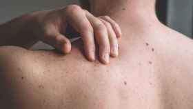 La revisión de lunares es una forma eficaz de prevenir el cáncer de piel.