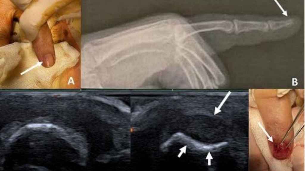 De izquierda a derecha y de arriba a abajo: la uña afectada, una radiografía, dos imágenes de la sonografía y la extracción del tumor.