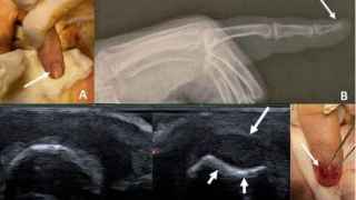 De izquierda a derecha y de arriba a abajo: la uña afectada, una radiografía, dos imágenes de la sonografía y la extracción del tumor.