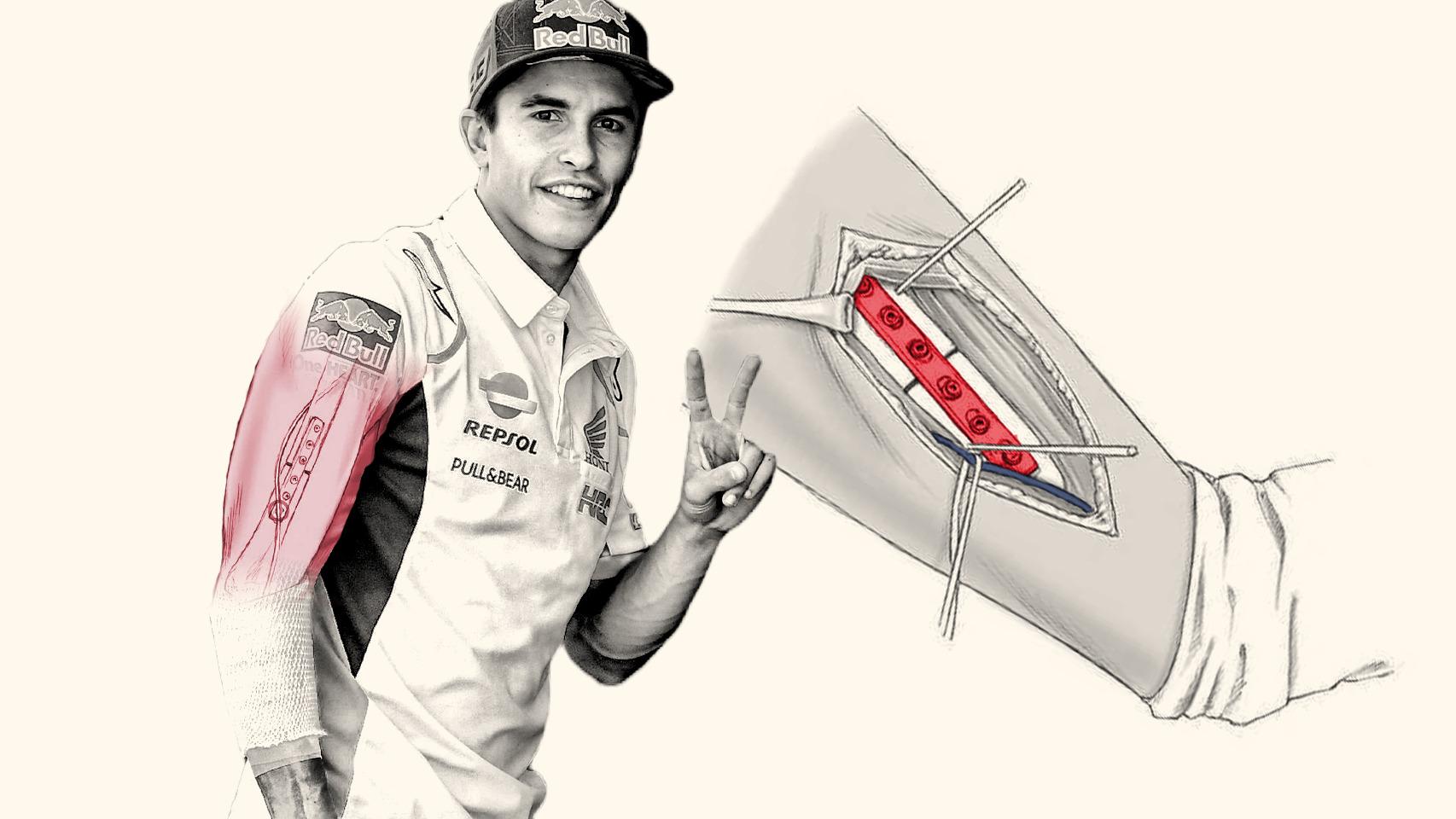 MotoGP: Marc Márquez se pronuncia sobre cómo está su brazo operado cuatro  veces