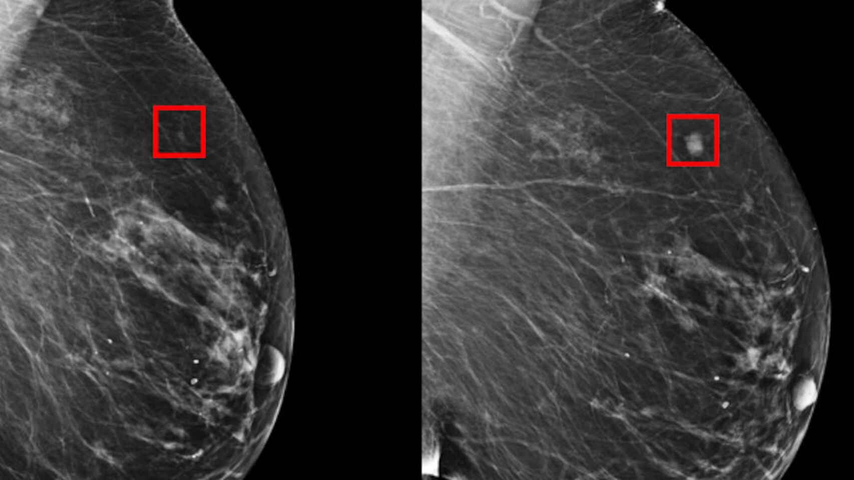 Imágenes de una mamografía de una paciente con cáncer de mama.