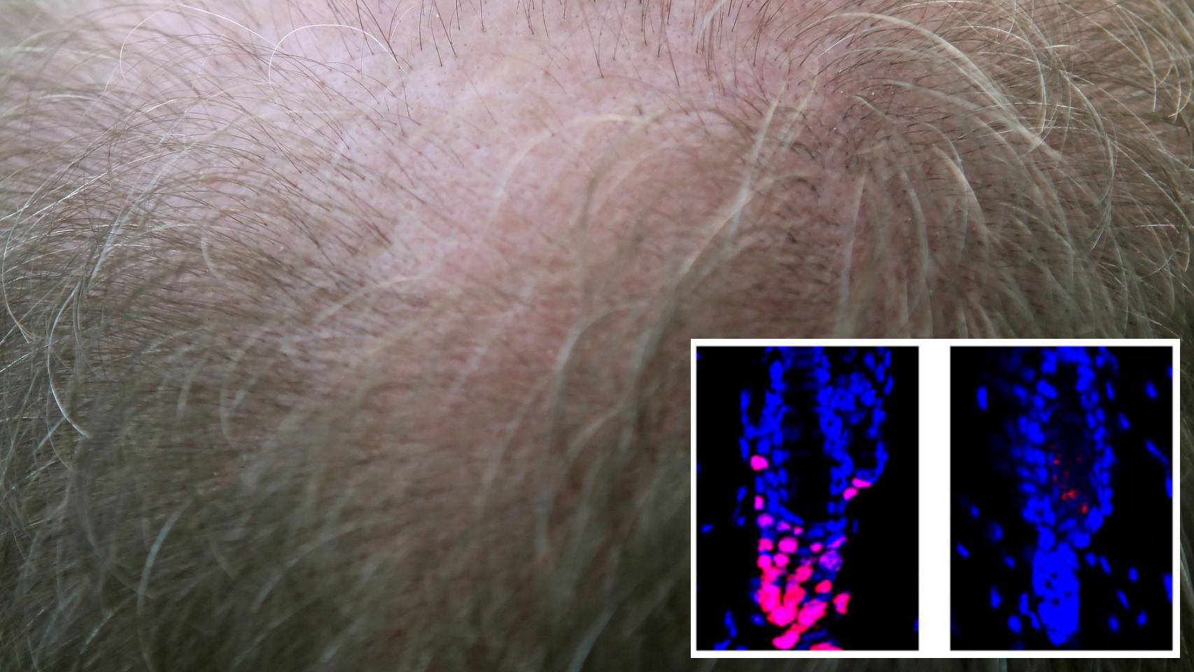 astronauta base Sociología Llega la segunda 'píldora' contra la calvicie: así es la nueva esperanza  contra la alopecia