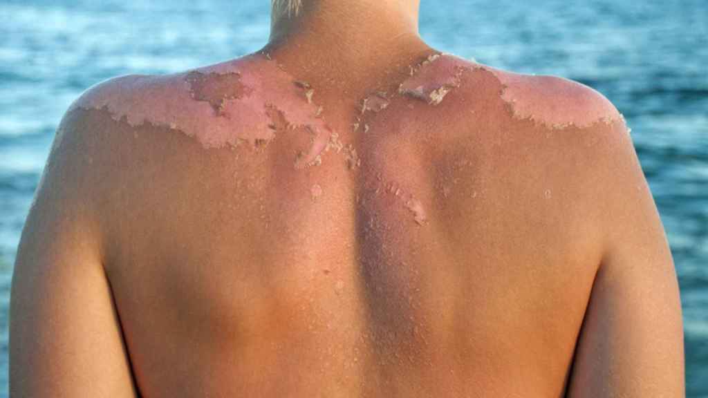 ¿Cómo evitar que la piel se pele tras tomar el sol?