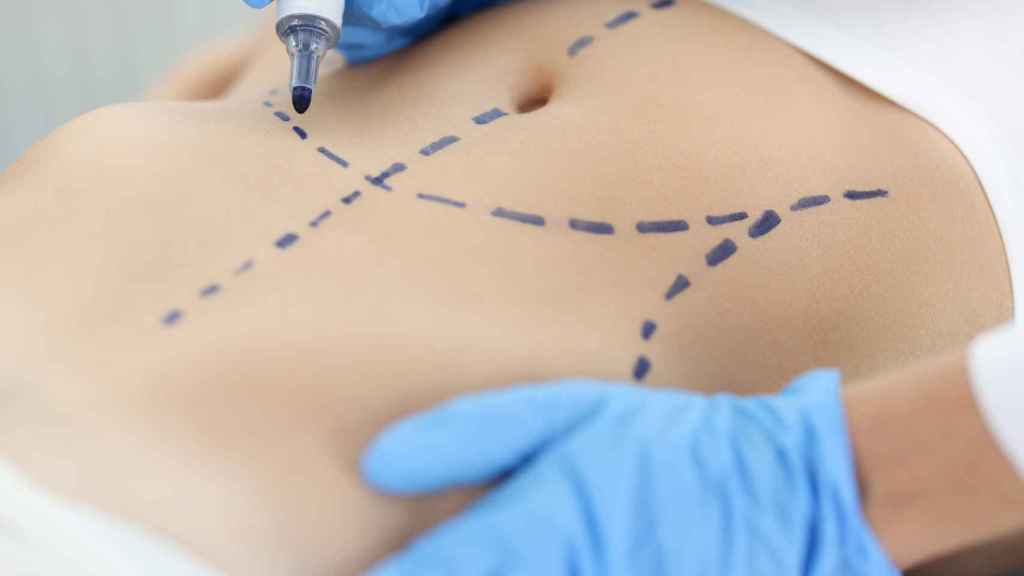 Médico cirujano plástico dibujando marcas preoperatorias en la piel del abdomen de la paciente.
