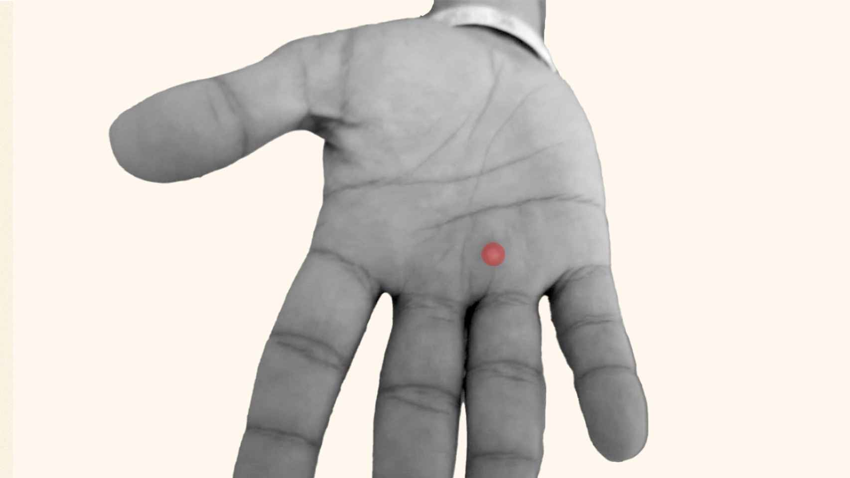 La mano de un paciente con una pústula señalada en rojo.