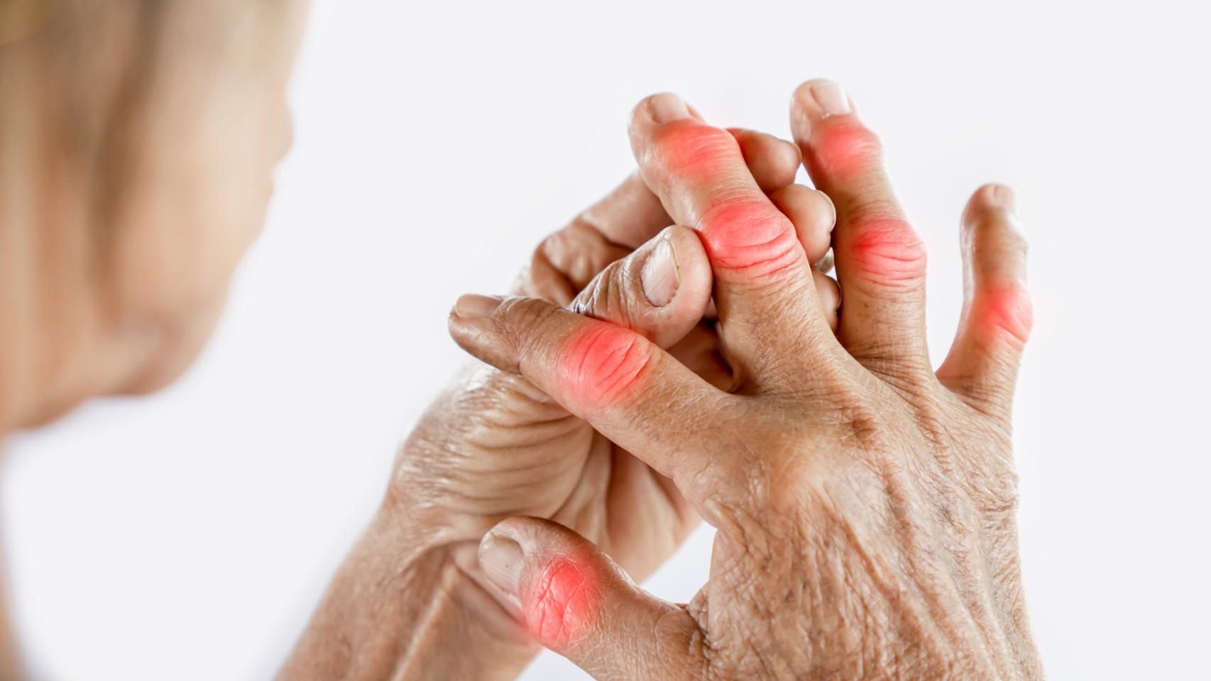 Los síntomas de la artrosis: así empieza la enfermedad sin cura que afecta  a 500M de personas