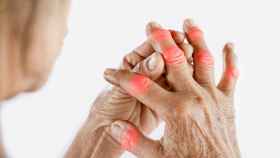 Los dolores en las articulaciones de los dedos son uno de sus principales síntomas.