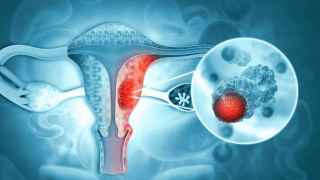 Estos son los síntomas del cáncer de cuello de útero: el tumor que cada vez afecta más a las mujeres
