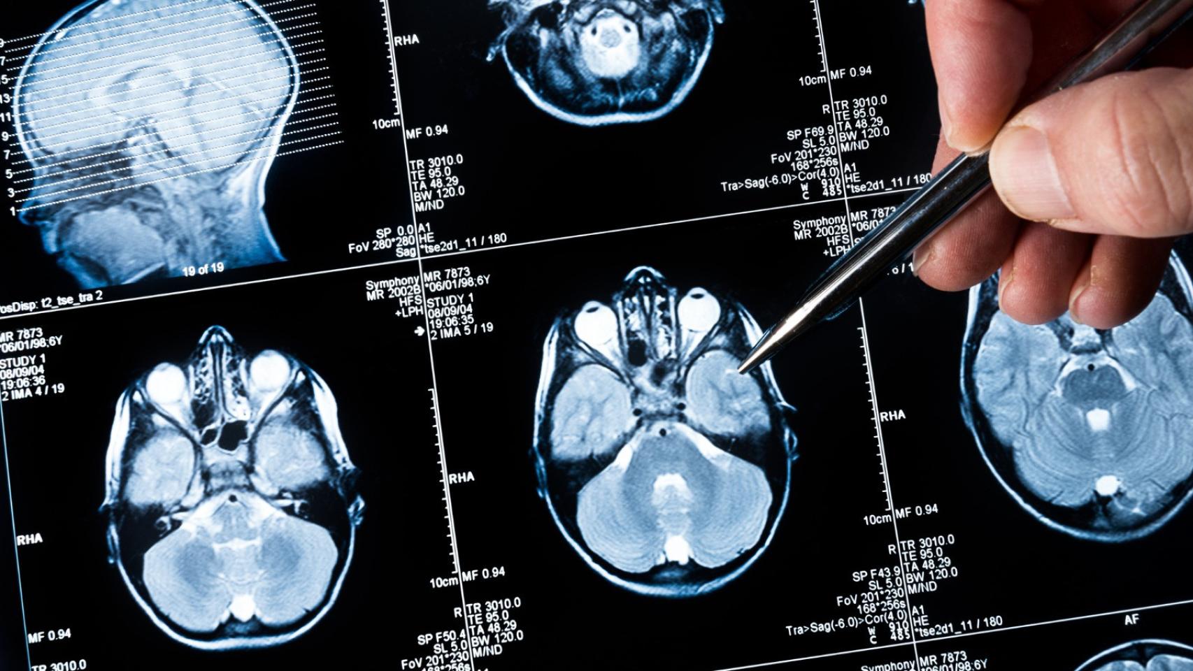 Un estudio gallego analizará la influencia del radón en el desarrollo de  tumores cerebrales